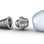 في عالم طب الأسنان الحديث، تبرز تقنيات زراعة الأسنان كإحدى أبرز الحلول المتقدمة لتعويض الأسنان المفقودة واستعادة الابتسامة الطبيعية. إذا كنت تبحث عن أخصائيين ذوي خبرة في هذا المجال، فإن مركز فيكتوريا لطب الأسنان في الشارقة يمثل الوجهة المثالية. يتميز المركز بتقديم خدمات زرع الاسنان في الشارقة بأحدث التقنيات، مع التركيز على الجودة والراحة في كل خطوة من خطوات العلاج. من خلال فريق من الأطباء المتخصصين والتقنيات المتطورة، يسعى مركز فيكتوريا لتوفير تجربة علاجية متميزة تُعيد لك الثقة في ابتسامتك وصحة فمك. في هذا المقال، سنتناول تفاصيل خدمات زراعة الأسنان في مركز فيكتوريا، مع تسليط الضوء على الفوائد التي يقدمها، وكيف يمكن أن تسهم هذه الخدمة في تحسين جودة حياتك. زرع الاسنان في الشارقة