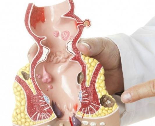 علاج البواسير في دبي: حلول فعّالة وآمنة للراحة الدائمة